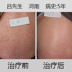 牛皮癣缠身五年 九州一月见奇效
