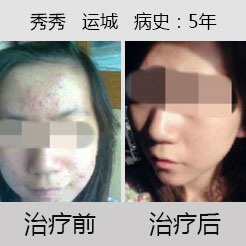 吹响战痘号角，为美丽战“痘”