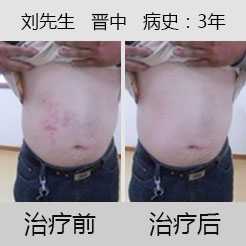 与荨麻疹抗争的日子