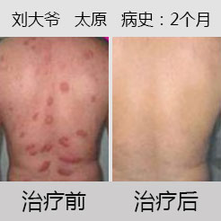 治愈荨麻疹 九州助半百老人获新生