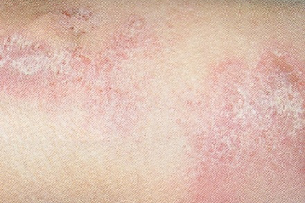 急性、亚急性、慢性湿疹分别有什么特征？