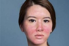 [晋中皮炎医院]激素性皮炎是什么