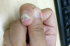 太原看灰指甲，灰指甲的常见危害