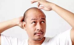 太原医院专家讲解导致人脱发的原因有哪些