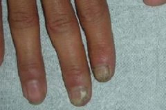 太原患者脚上灰指甲是怎么引起的，灰指甲怎么