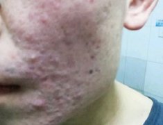 太原人脸上青春痘留下的疤痕怎么去除，有什么