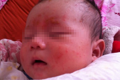 婴儿为什么会出现湿疹呢？