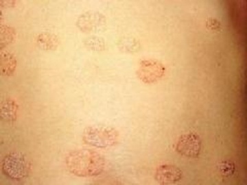 股癣发病因素有哪些?男性患者尤其注意！